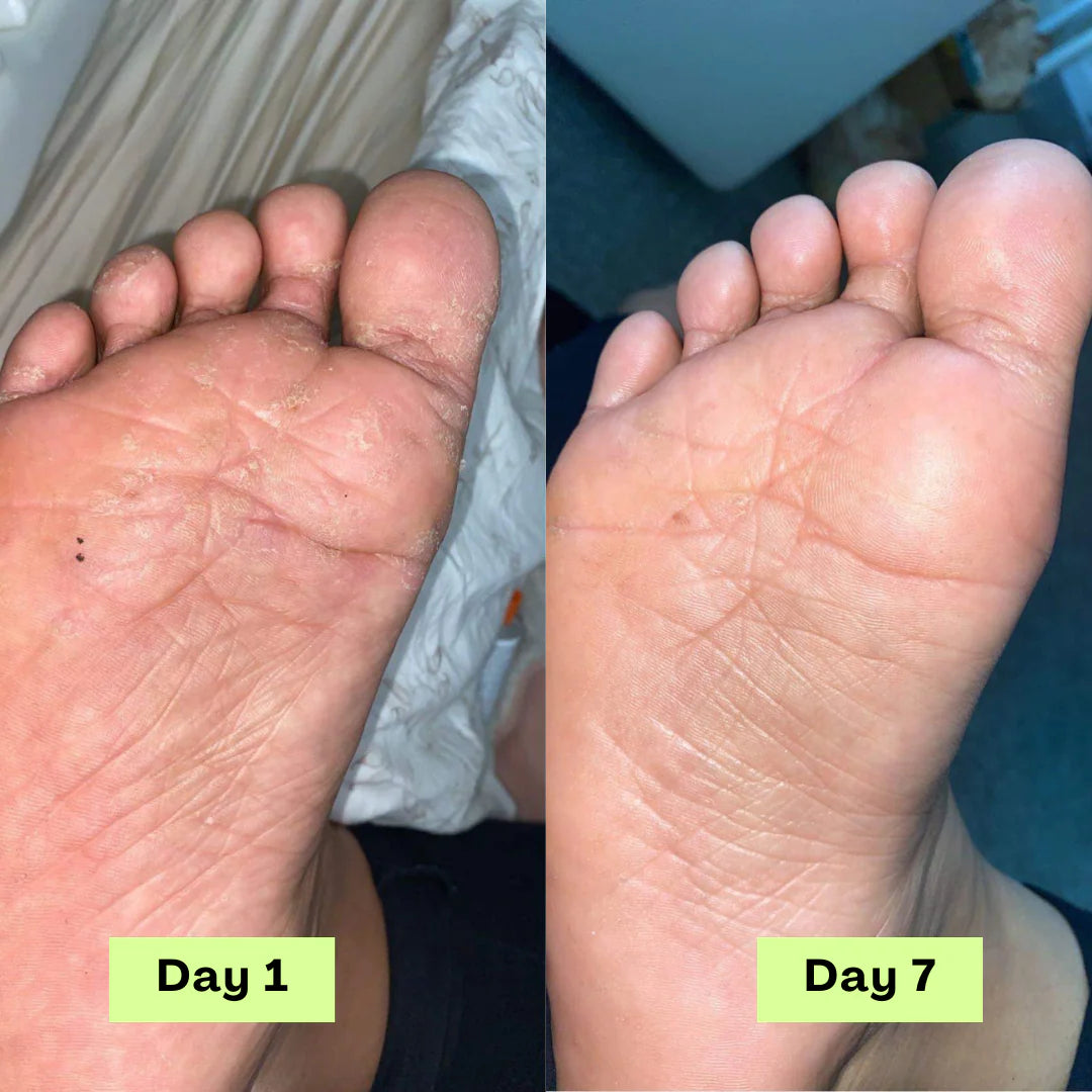 Loravey® AntiFungal Relief Soap Bar